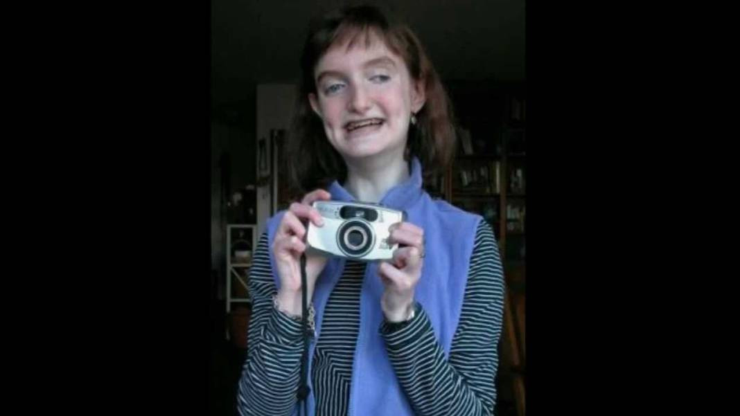 Dünyanın En Sıra Dışı 10 Hastalığı: Tıbbın Gizli Dünyası - Resim: 5